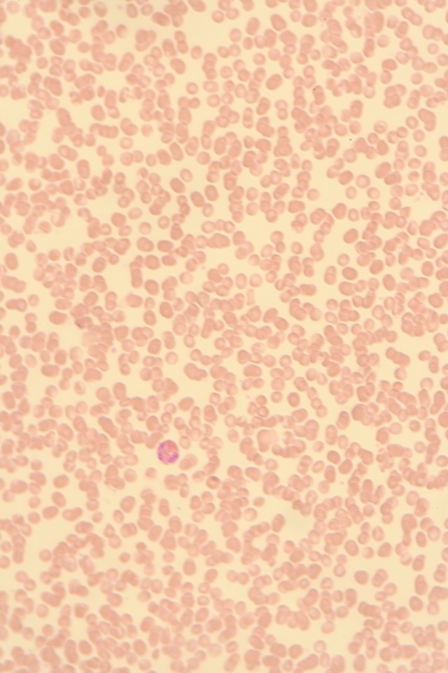 Blood smear with eosinophil