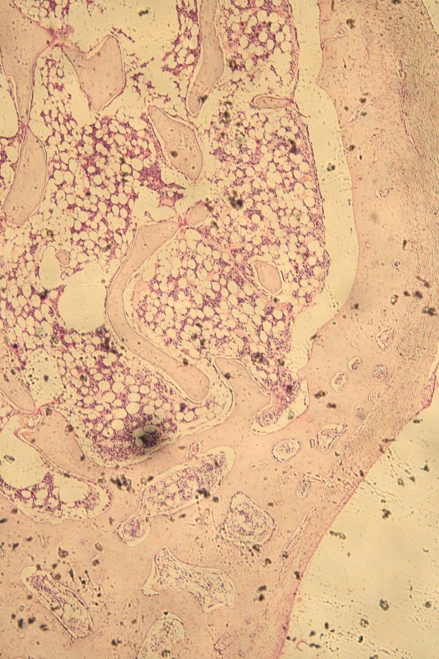 cancellous (spongy) bone
