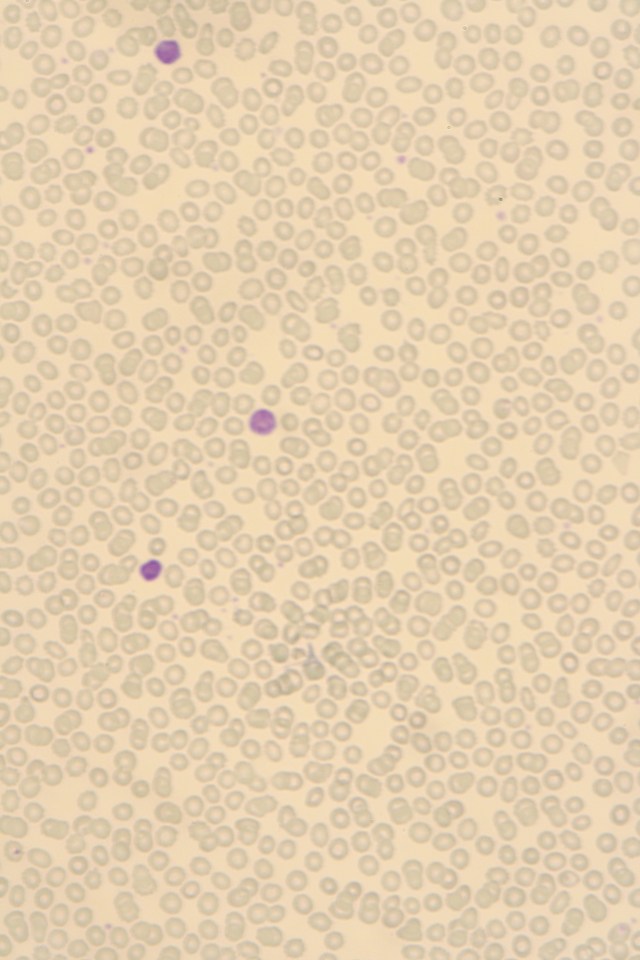 chronic lymphocytic leukemia