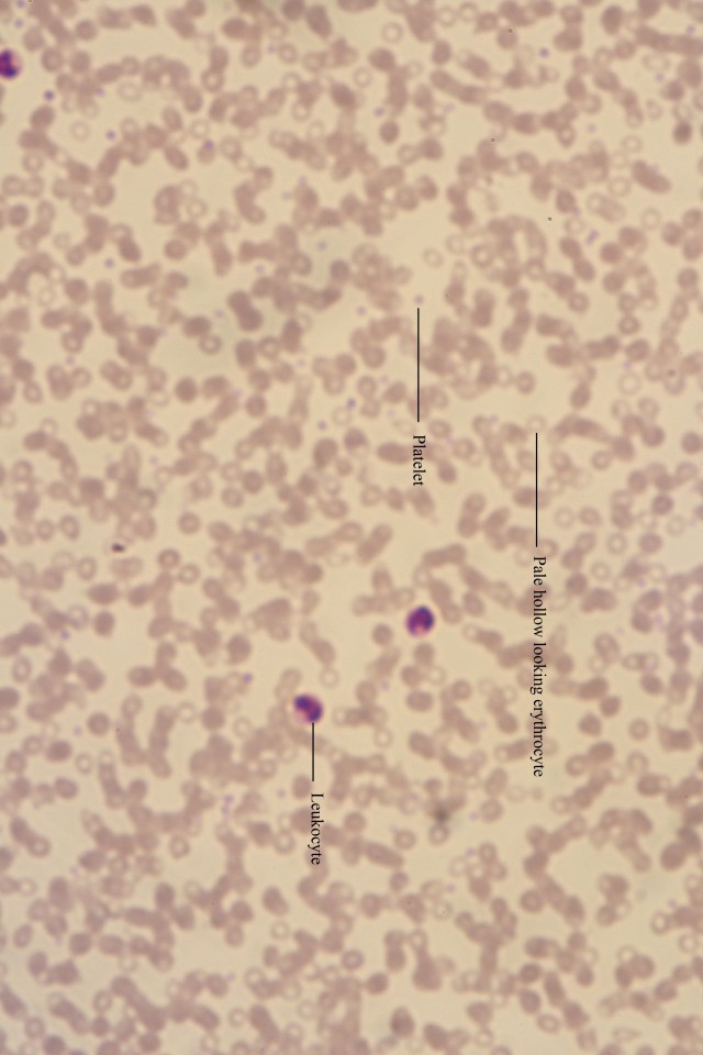 Cooleys anaemic blood (labelled)