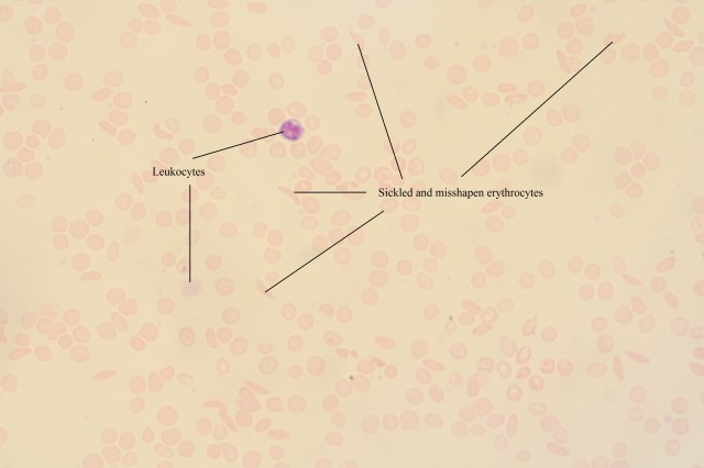 Sickle Cell Anaemia (labelled)